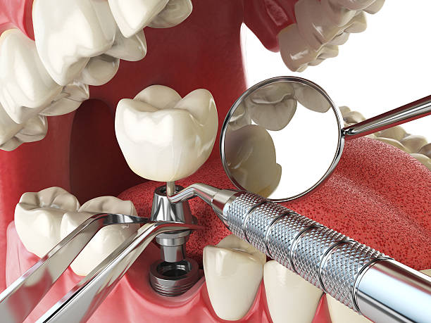 Best Chipped Tooth Repair Near Me  in Rapid Valley, SD